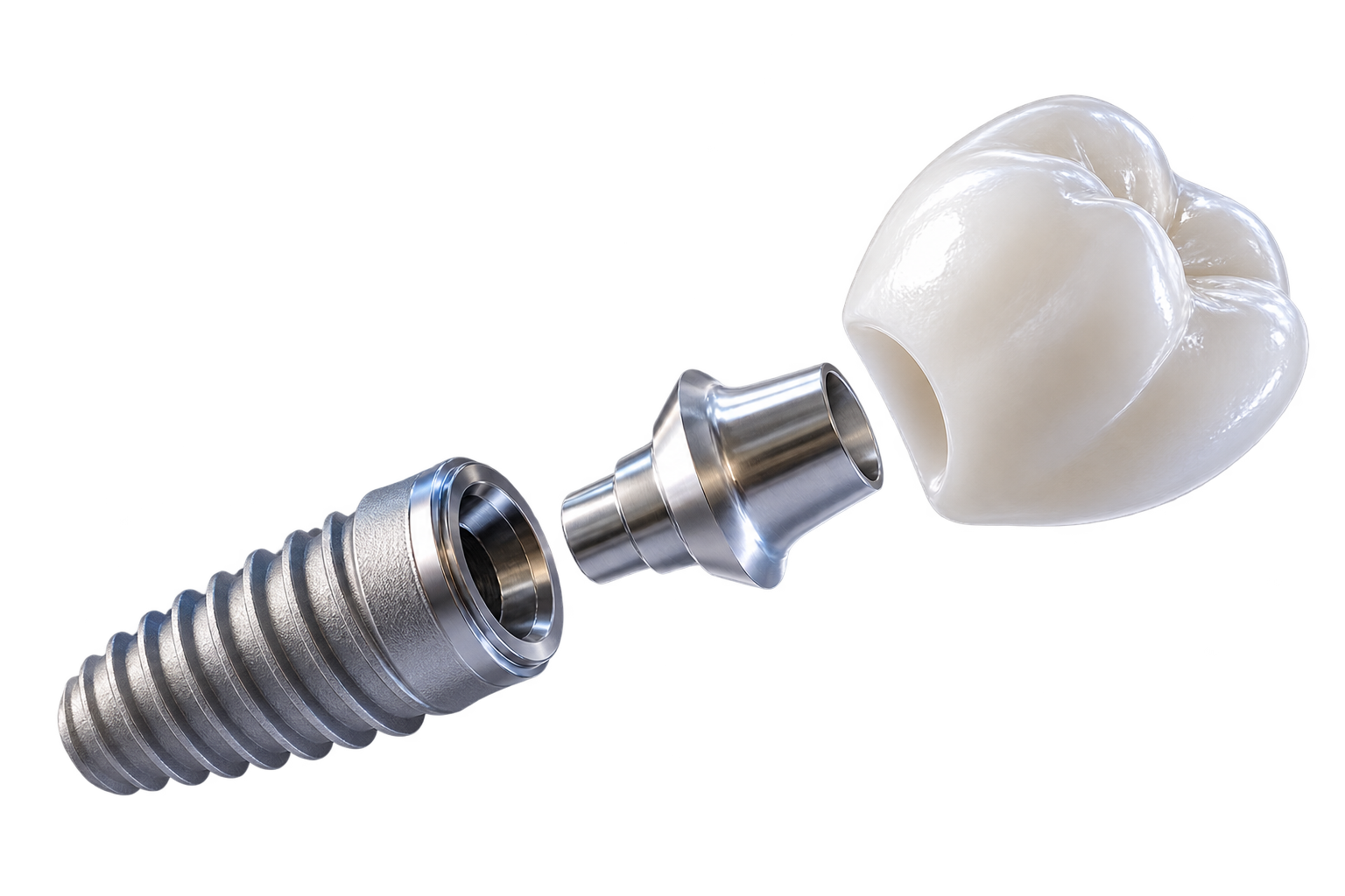 Implant dentar