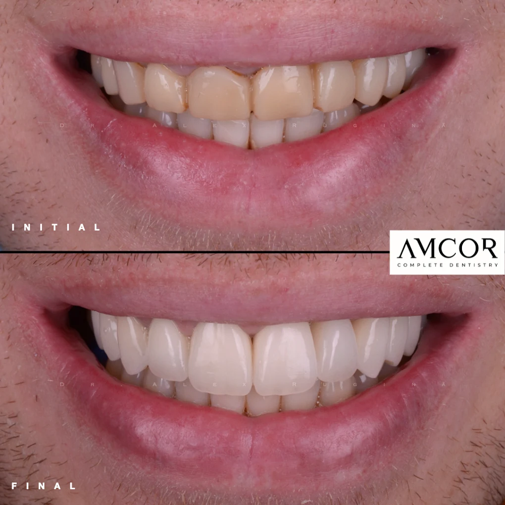 Caz clinic Amcor — reabilitare estetică, înainte și după