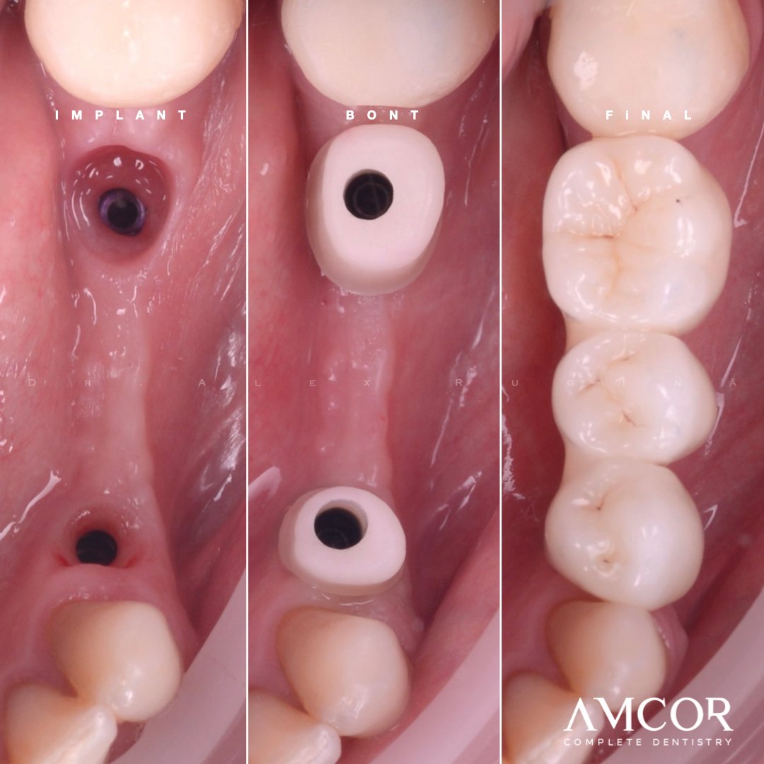 Implant dentar — clinica AMCOR